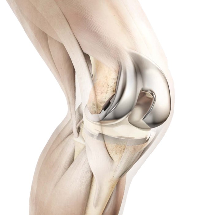 knee-replacement